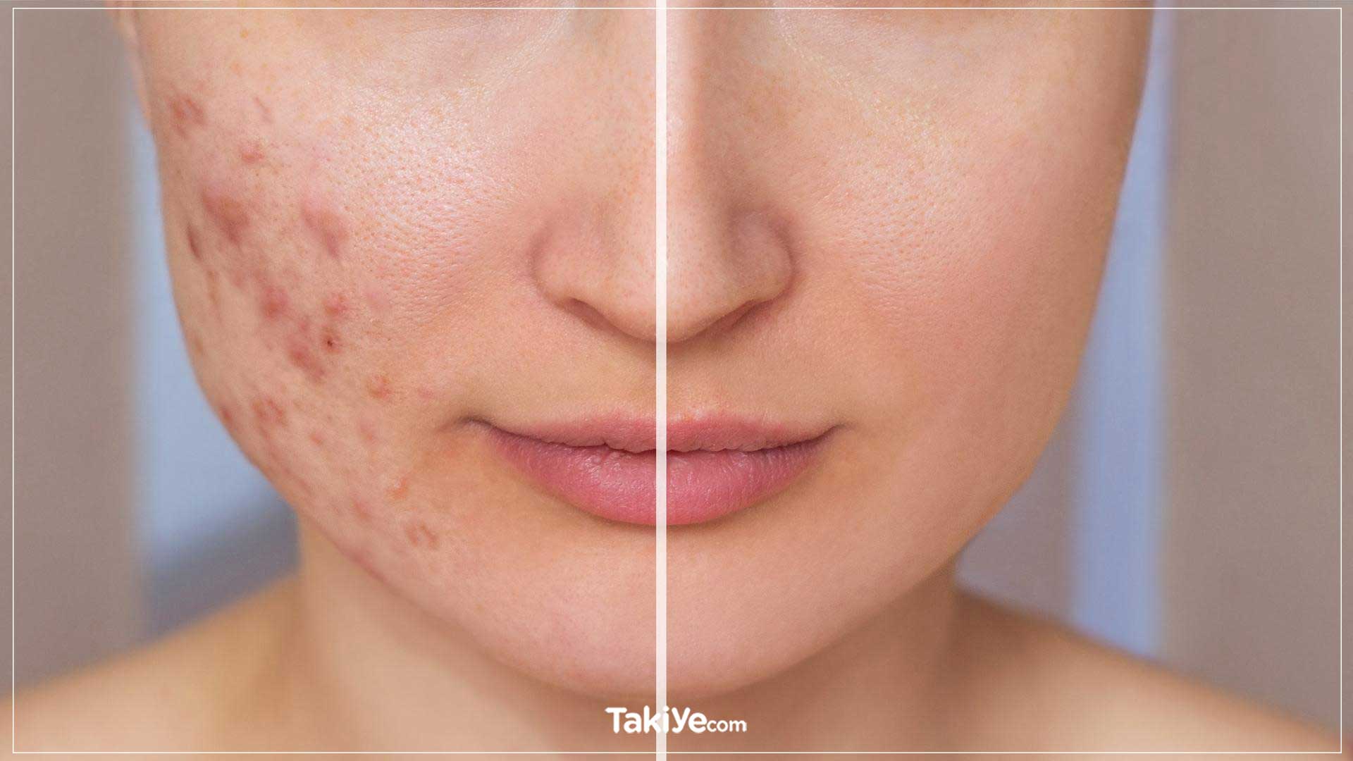 roaccutane nedir. roaccutane fiyat. roaccutane kullananlar. roaccutane tedavisi. zararları.